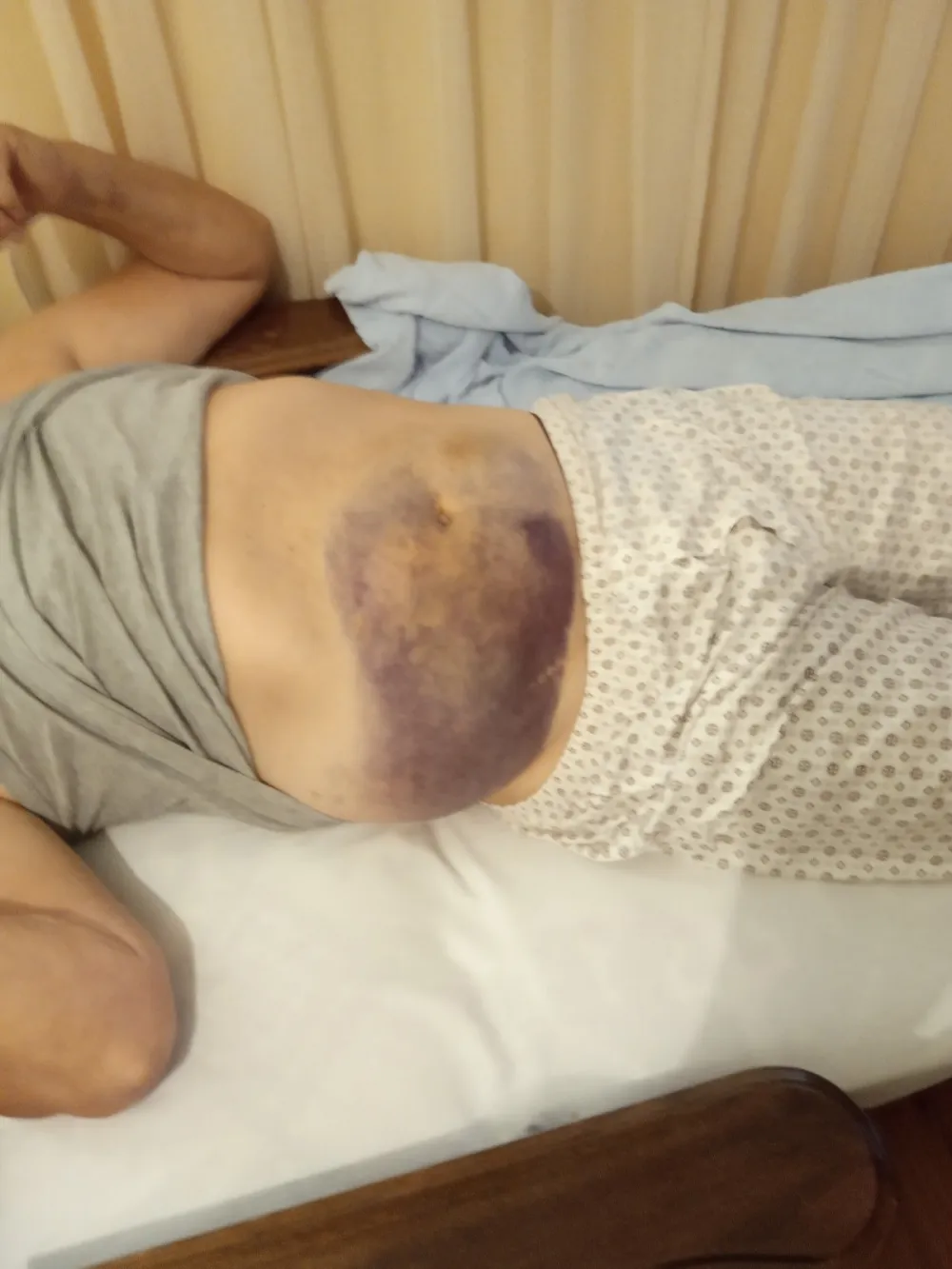 У отпусној листи не помињу повреду, породица Љумовић поднијела пријаву против барске болнице