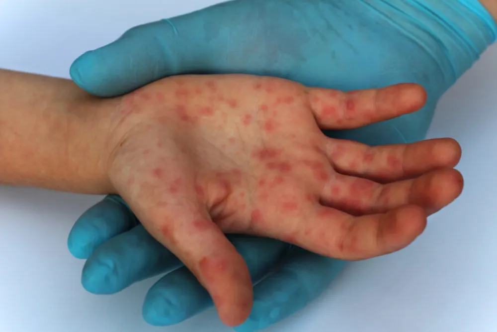 Progla&scaron;ena epidemija morbila u Banjaluci