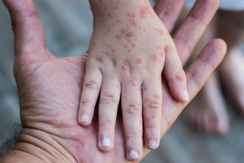Epidemija morbila i u Podgorici, registrovana tri nova slučaja