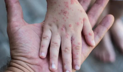 Nevakcinisano svako drugo dijete u vrtićima