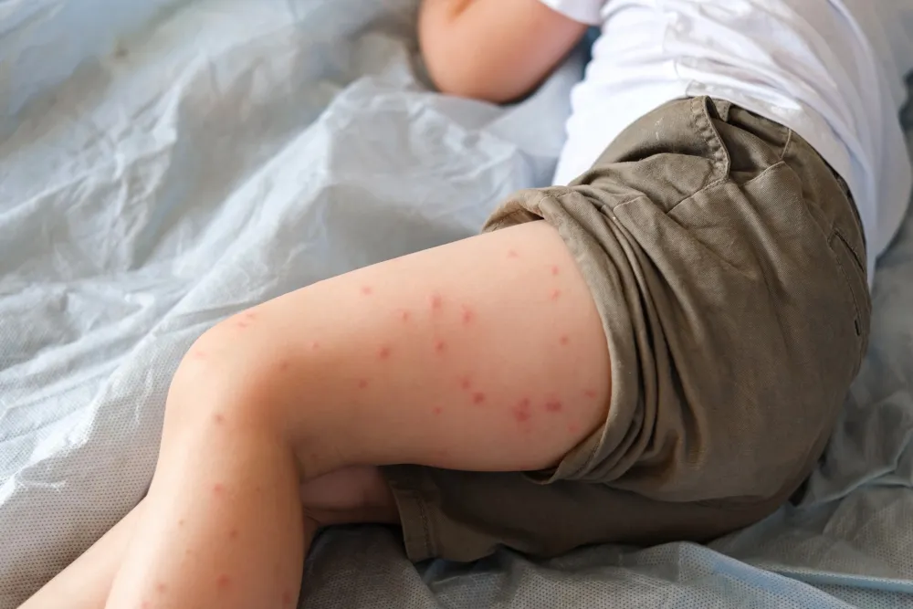 Epidemija malih boginja &scaron;iri se Londonom: Evo &scaron;ta je važno da zna svaki roditelj
