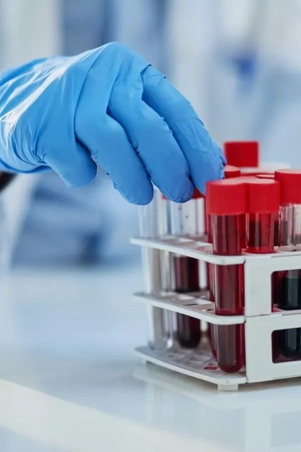 Krvni test otkriva znakove Alchajmerove bolesti "decenijama prije simptoma"