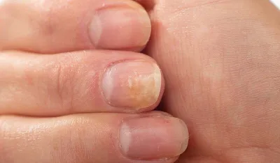 Kako prepoznati simptome psorijaze noktiju i na koji način ublažiti tegobe